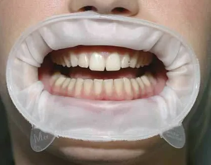 Фото №0 Оптрагейт