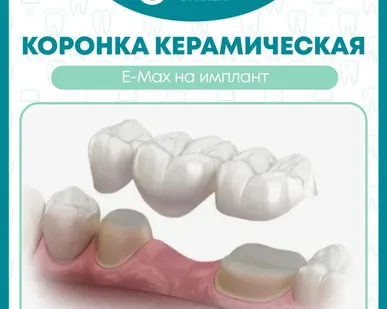 фото Коронка керамическая E-Max на имплант