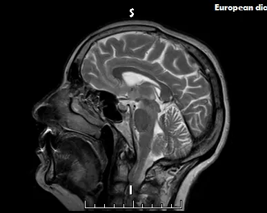 фото Контрастное усиление 15мл Дотарем, включает 15 мл контрастного вещества. При массе тела 50-75 кг.