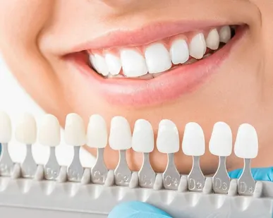 фото Виниры