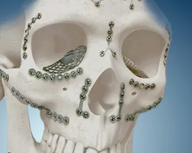 фото Пластины для челюстно лицевой хирургии в Москве