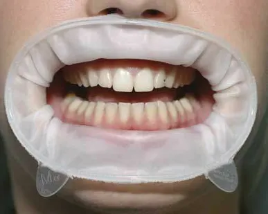 фото Оптрагейт