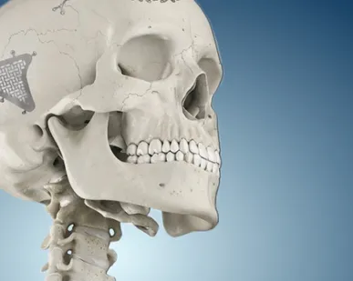 фото Пластины для краниопластики в Москве