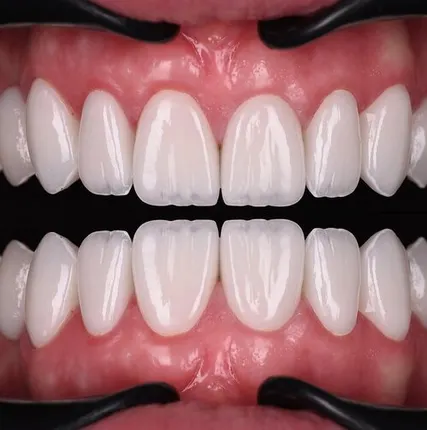 Фото №0 Композитные виниры