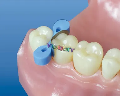 фото Штифты позолоченные внутриканальные М1 N12